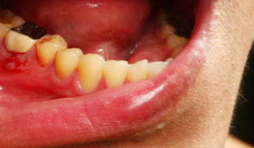 New Research May Shed Light on New Treatments for Periodontal Disease