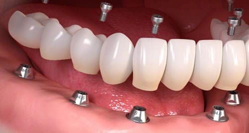 Full Arch Dental Implants