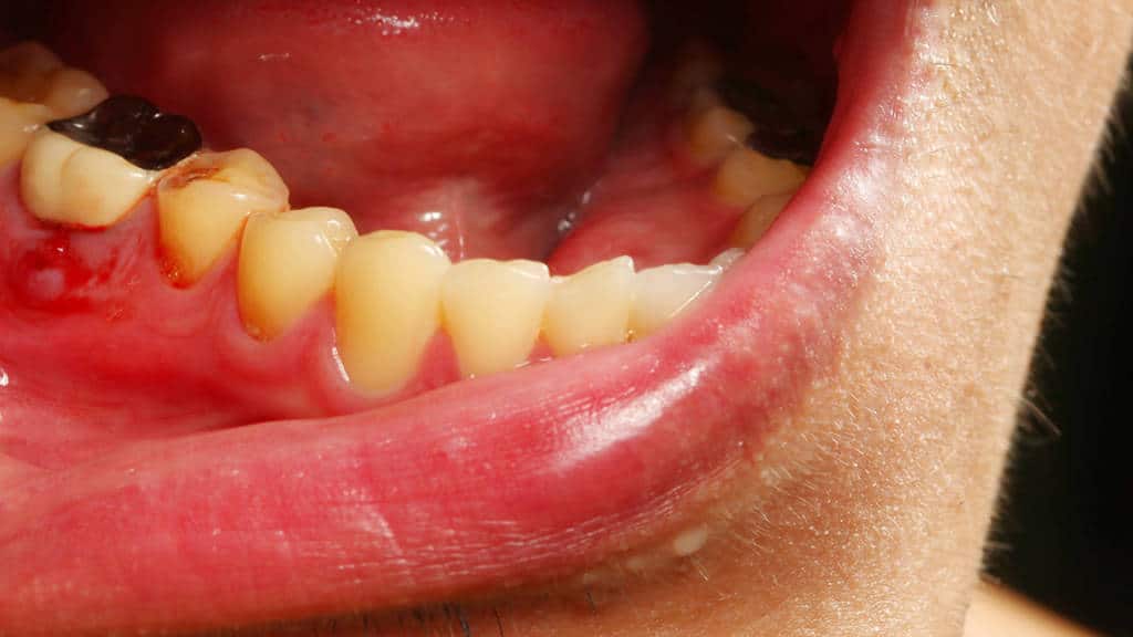 Root Canal, Abscess Tooth Purpose, Procedures & Risk Dr. Suffoletta's