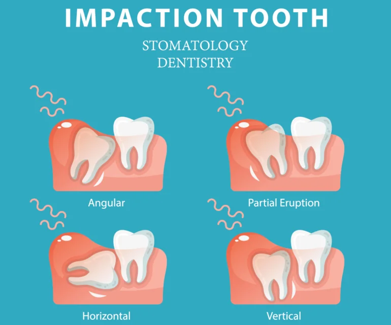 Impacted Wisdom Teeth Pain Impacted Wisdom Teeth Pain