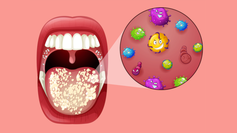 Can Oral Probiotics Prevent and Help Treat Gum Disease?