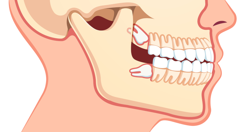 Warning Signs of Impacted Wisdom Teeth 1