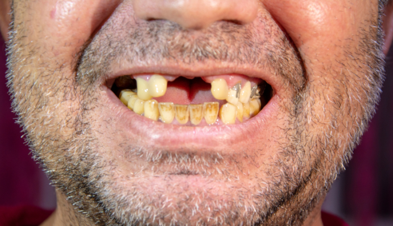 Can Proper Oral Care Help Recovering Drug Addicts?