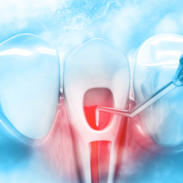 Laser Dentistry in Endodontic Treatments, Is it Safe for You?