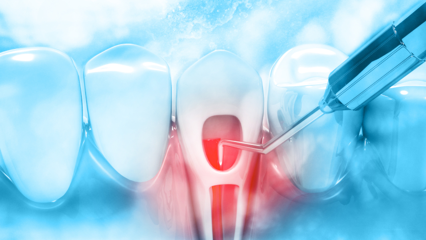 Laser Dentistry in Endodontic Treatments | Dr. Suffoletta Dentistry