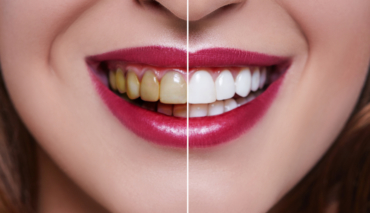 Cosmetic Dental Procedures that Help Better Your Lifestyle