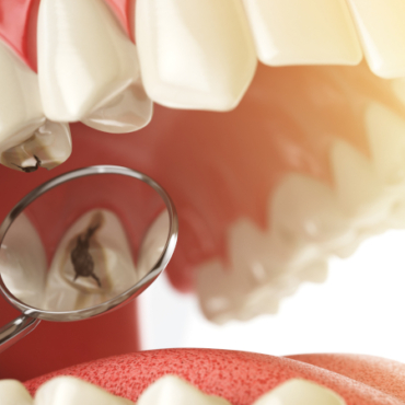 Dental Crown VS A Filling: Why you Should Opt in for a Ceramic Crown
