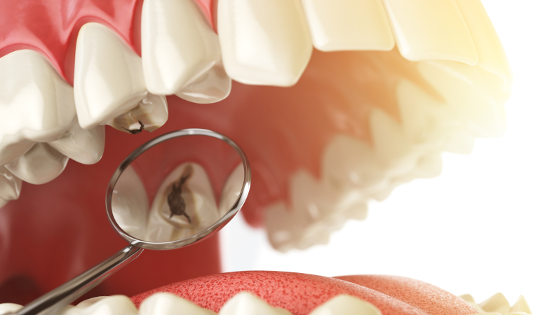 Dental Crown VS A Filling: Why you Should Opt in for a Ceramic Crown