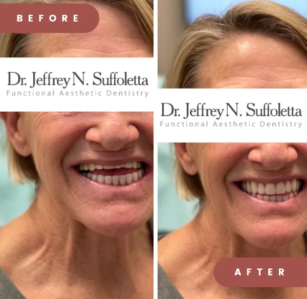 Before and After Smile Rehabilitation