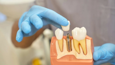 What are Dental Crowns? Purpose And Procedure