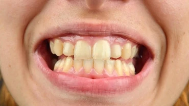 Laser Frenectomy Helps Gum Recession