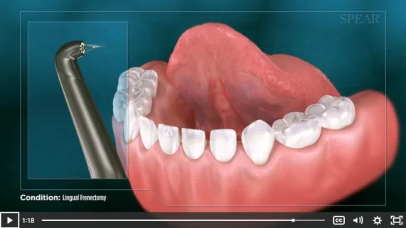 Laser Frenectomy Patient Educational Video