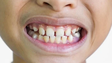 Laser Frenectomy Helps Prevent Potential Crowding