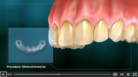Teeth Whitening Educational Video