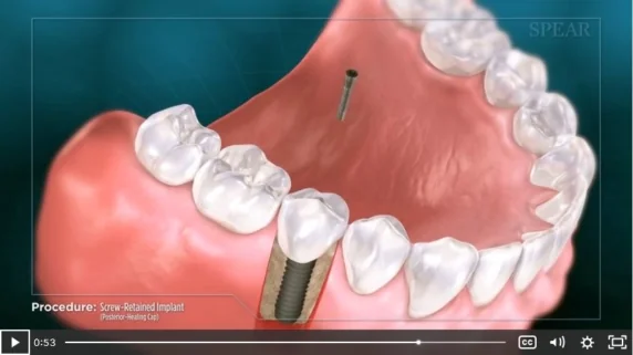 dental implant procedure video