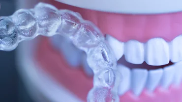Keep Your Teeth Straight with Clear Aligners