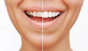 What are the Current Developments in Dental Veneers?