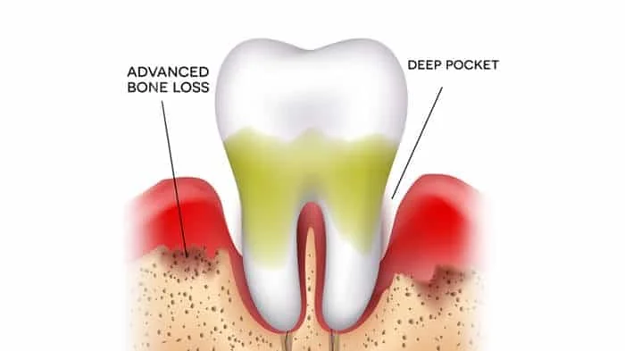 Stage Three Gum Disease