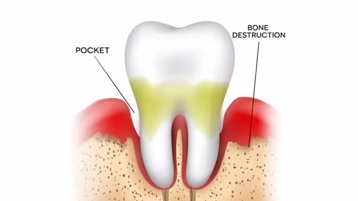 Stage Two Gum Disease