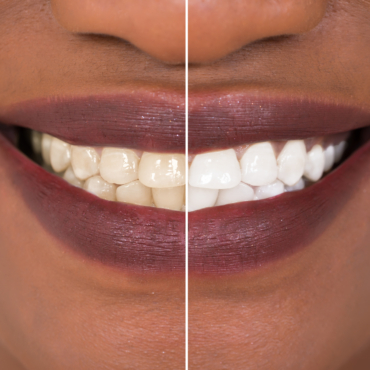 Unraveling the Secrets of Teeth Whitening