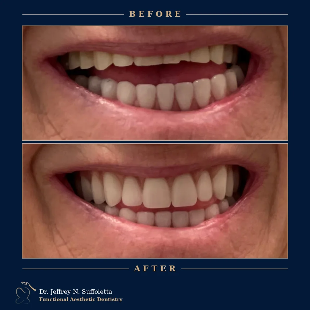 Before and After Aesthetic Dental Treatment Before and After Aesthetic Dental Treatment