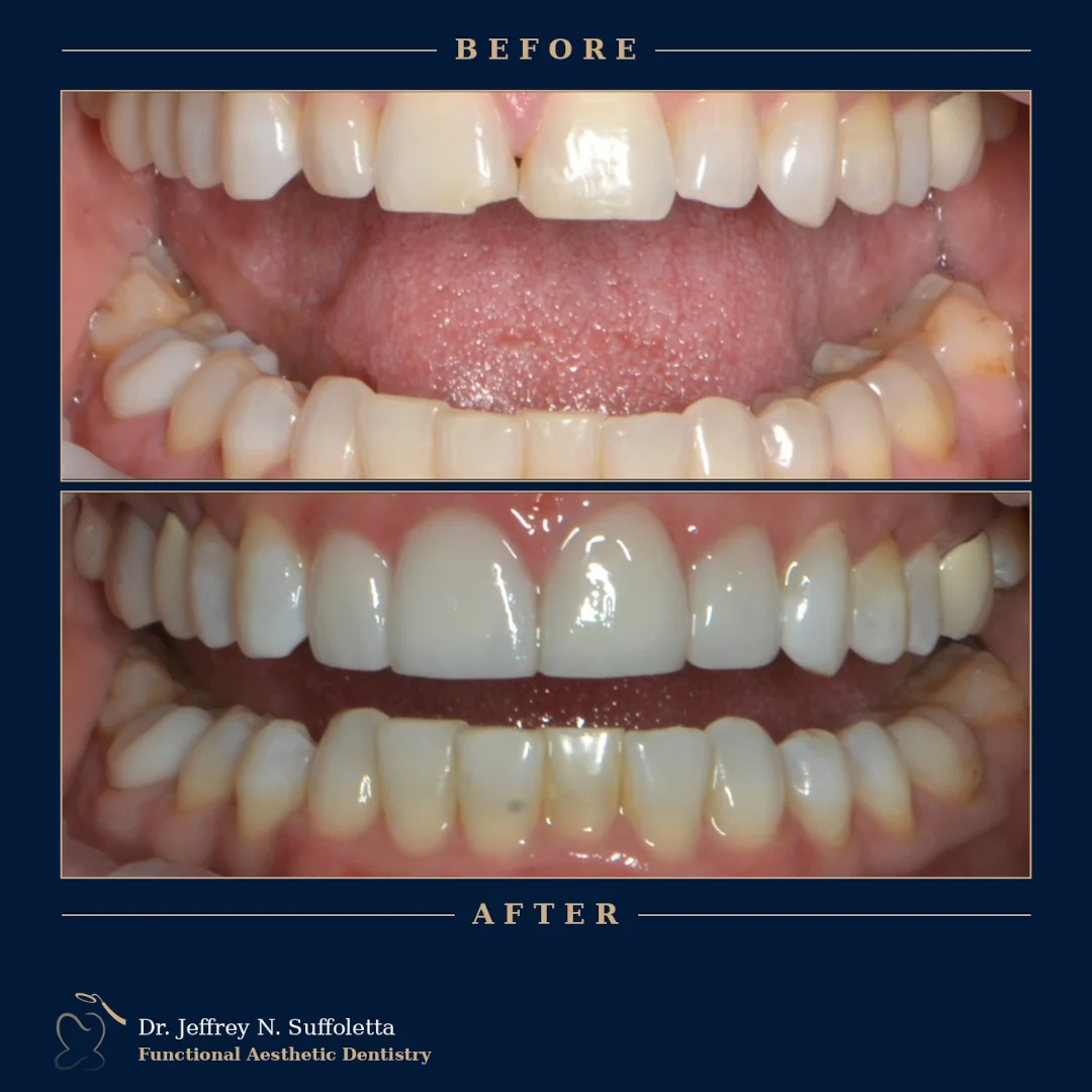Before and After Cosmetic Dental Treatment Las Vegas Before and After Cosmetic Dental Treatment Las Vegas