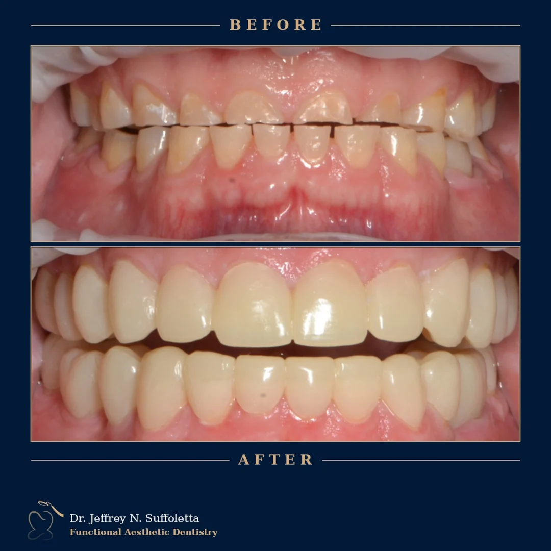 Before and After Dental Treatment Before and After Dental Treatment